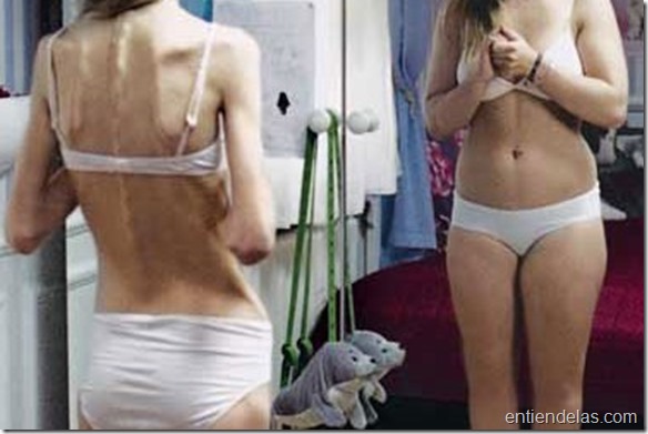 Anorexia y Bulimia, un mal que persiste entre la juventud